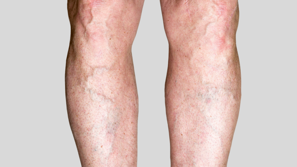 Varicose veins Surgery in Guntur.